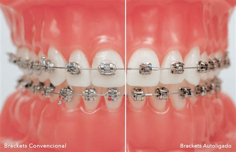 bracket metalicos precios|brackets de autoligado.